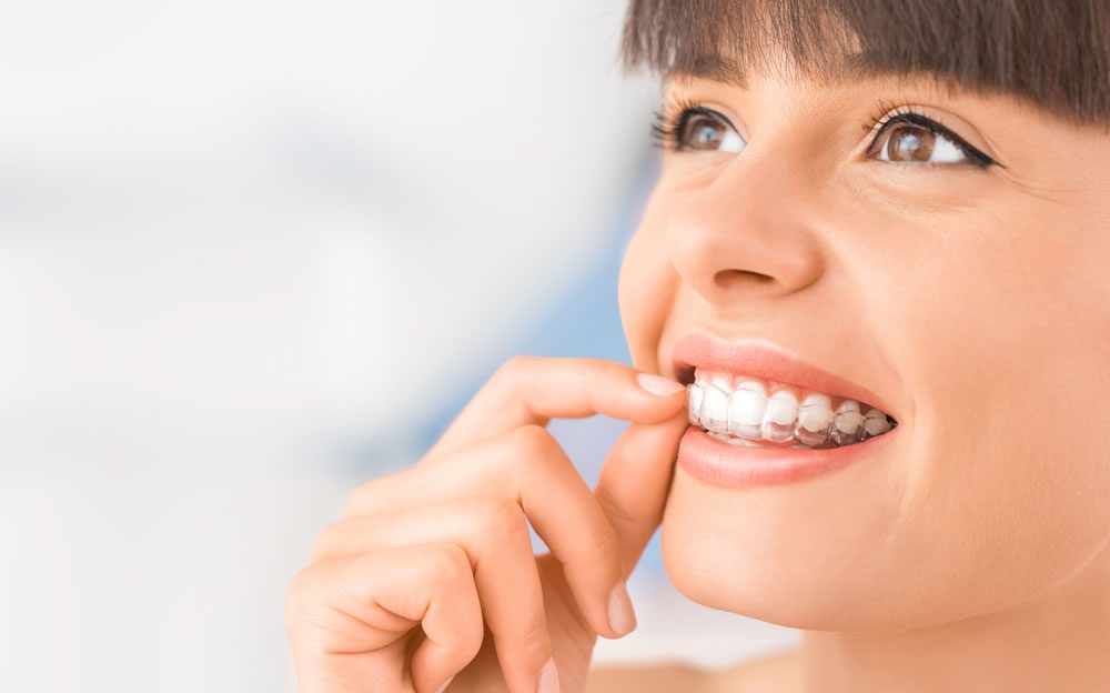 Sonrisa con un tratamiento de ortodoncia invisible