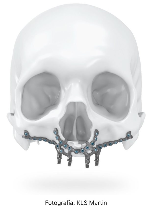 Implantes Subperiósticos